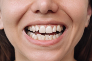 Dentes Desalinhados: problemas que vão além da estética